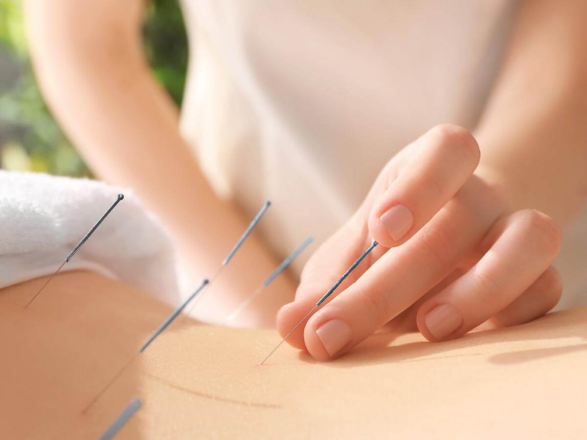 Acupuncture & Dry Needling - Wellers Hill Physiotherapy Brisbane