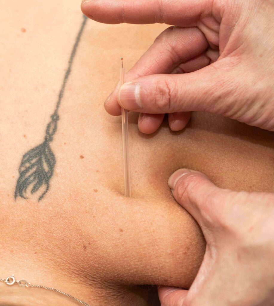 Physiotherapist performing dry needling treatment as part of the physiotherapy services at Wellers Hill
