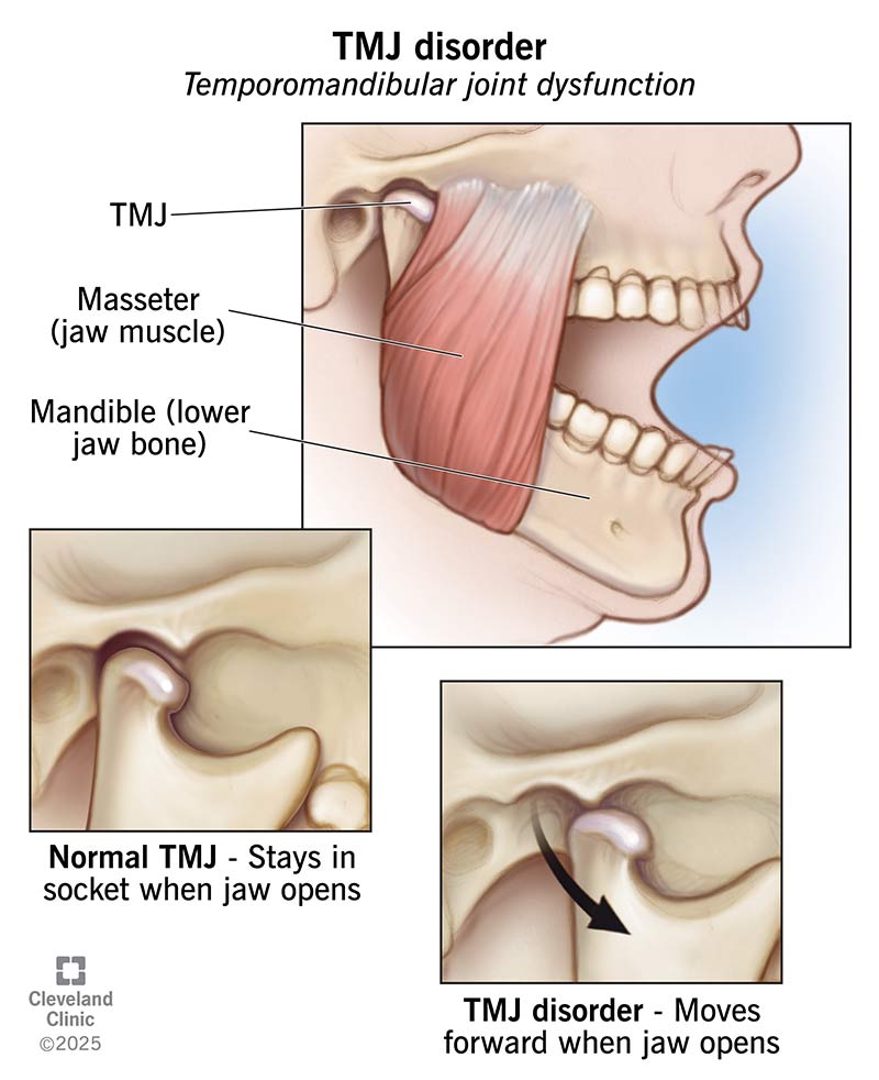 Anatomical diagram showing the muscles of the jaw involved in temporomandibular joint (TMJ) movement