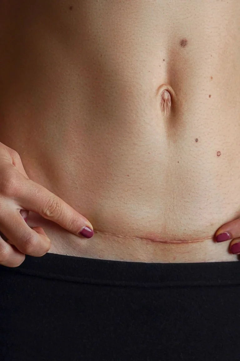 Person with C-section scar receiving scar release treatment to improve mobility and reduce tightness
