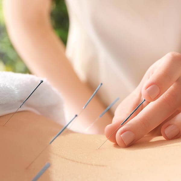 Acupuncture & Dry Needling - Wellers Hill Physiotherapy Brisbane